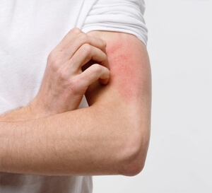 Skin Diseases
